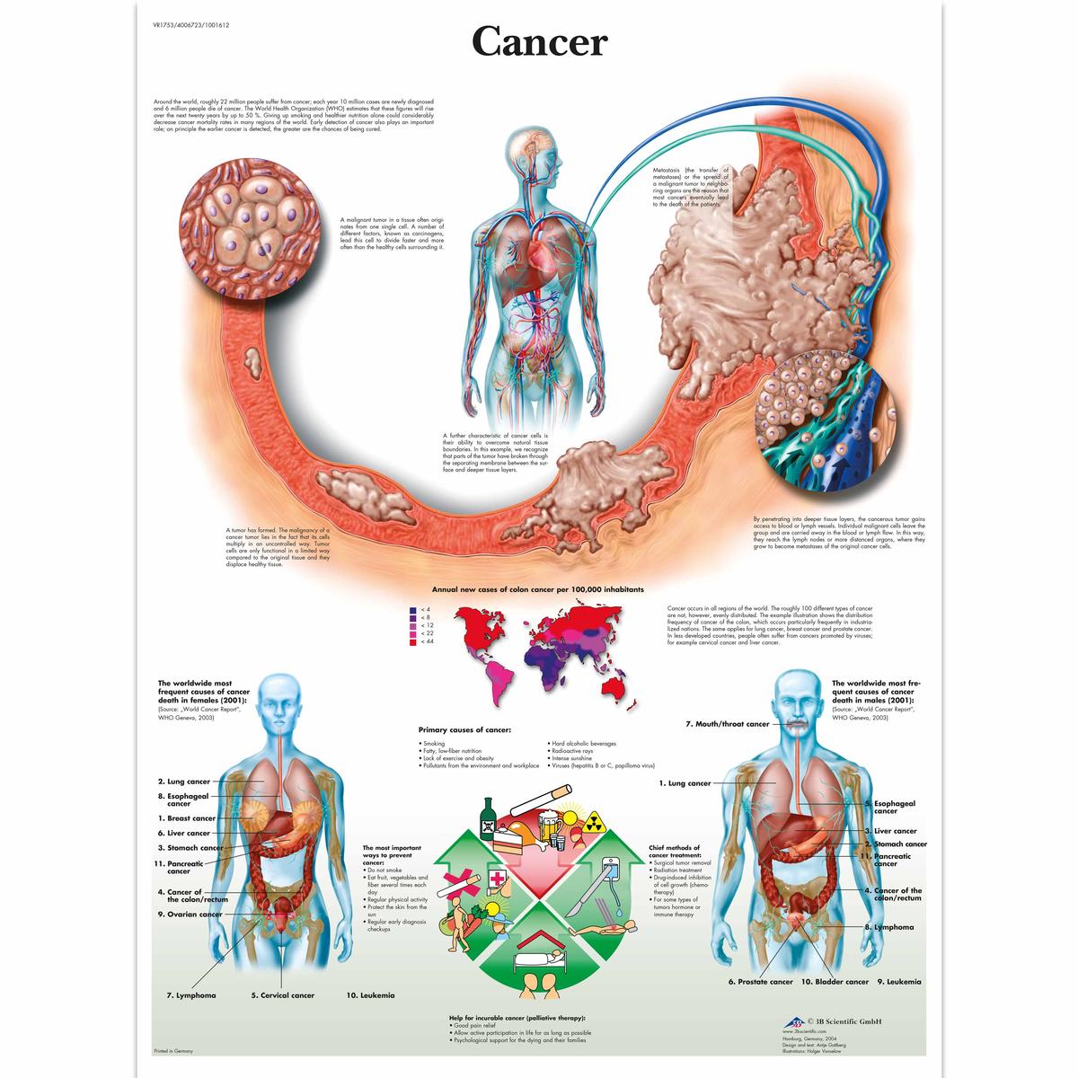 암 차트 Cancer Chart VR1753L [1001612]