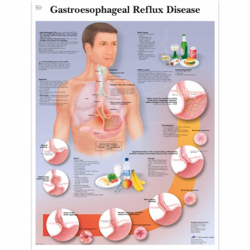 역류성 식도염 차트 Gastroesophageal Reflux Disease Chart (GERD) VR1711L [1001602]