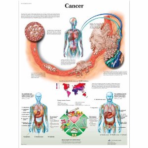 Cancer Chart VR1753L [1001612]