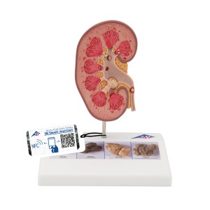 [특별할인] 신장결석 모형 Kidney Stone Model K29 [1000316]
