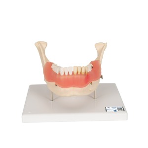 치아 질환 모형 Dental disease, magnified 2 times, 21 parts D26 [1000016]