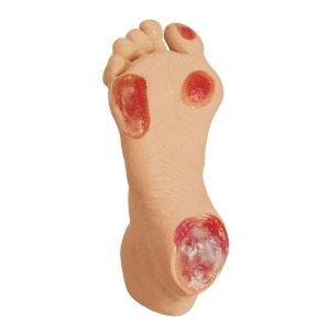 노인성 욕창 발 Elderly Pressure Ulcer Foot W44757 [1013058]