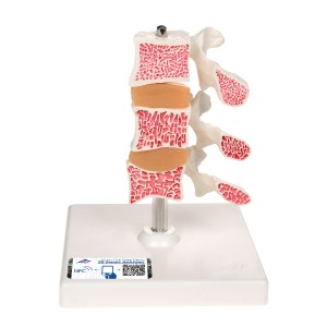 골다공증 모형 (3개의 척추) Deluxe Osteoporosis Model (3 Vertebrae) A78 [1000153]