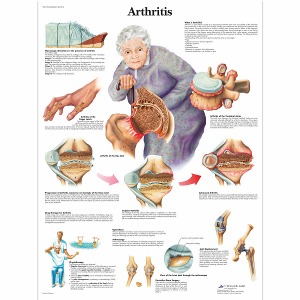 관절염 차트 Arthritis Chart VR1123L [1001474]