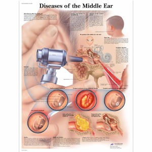 중이염 차트 Diseases of the Middle Ear Chart VR1252L [1001506]
