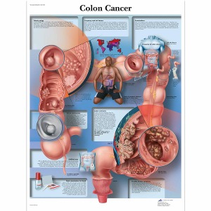 대장암 차트 Colon Cancer Chart VR1432L [1001550]