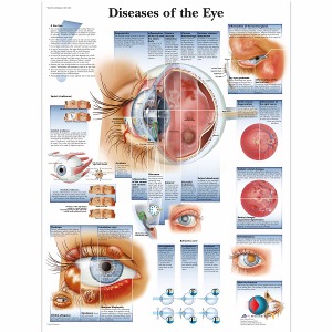 안구 질병 차트 Diseases of the Eye Chart VR1231L [1001498]