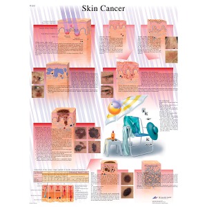 피부암 차트 Skin Cancer Chart VR1295L [1001514]