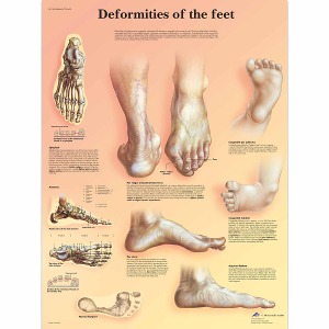 발 기형 차트 Deformities of the Feet Chart VR1185L [1001492]