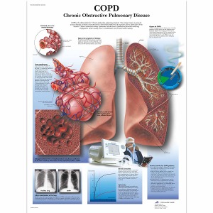 만성 폐 질환 차트 COPD Chart- Chronic Obstructive Pulmonary Disease VR1329L [1001522]