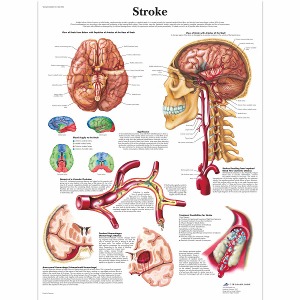 뇌졸중 차트 Stroke Chart VR1627L [1001590]