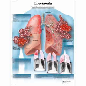 폐렴 차트 Pneumonia Chart VR1326L [1001518]