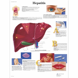 간염 차트 Hepatitis Chart VR1435L [1001552]